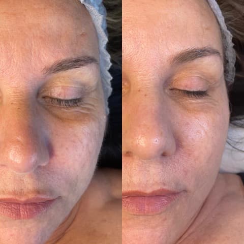 Microneedling